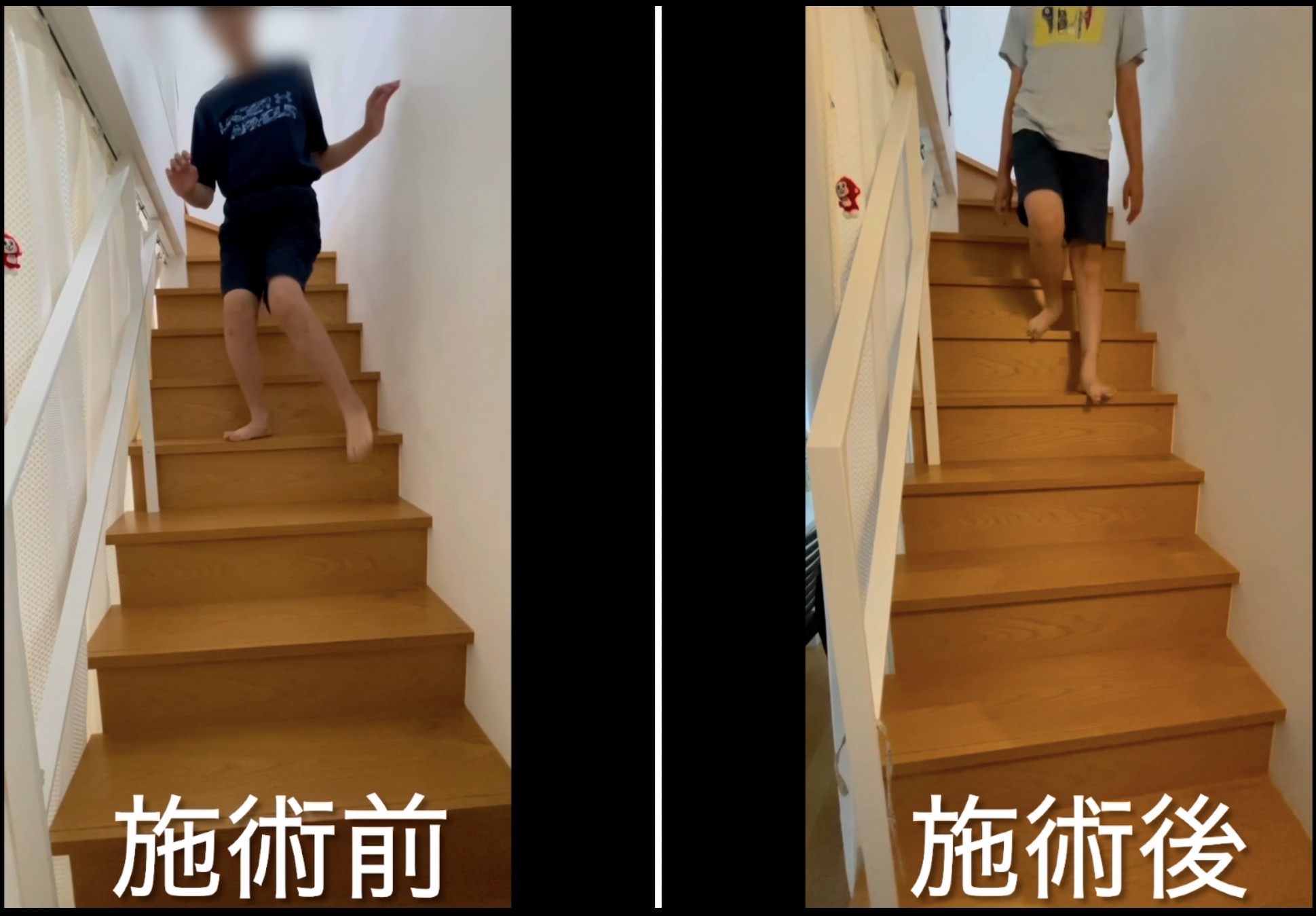 手術後の後遺症階段の上り下り改善